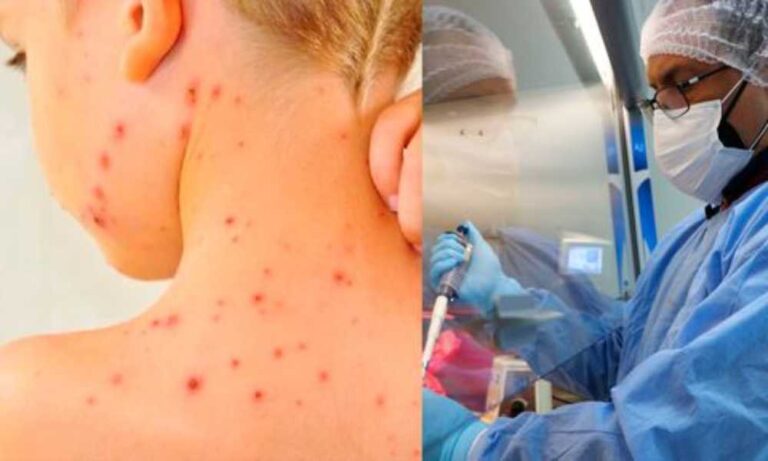 Virólogos advierten que viruela del mono se ha convertido en ‘virus hipermutado’