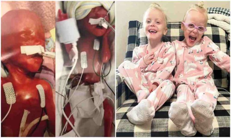 Mellizas más prematuras del mundo nacieron antes del límite para abortar